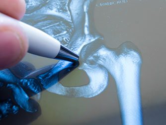 Fracture Care